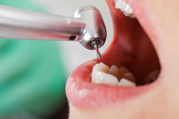 Best Emergency Tooth Extraction in Madisonville, LA